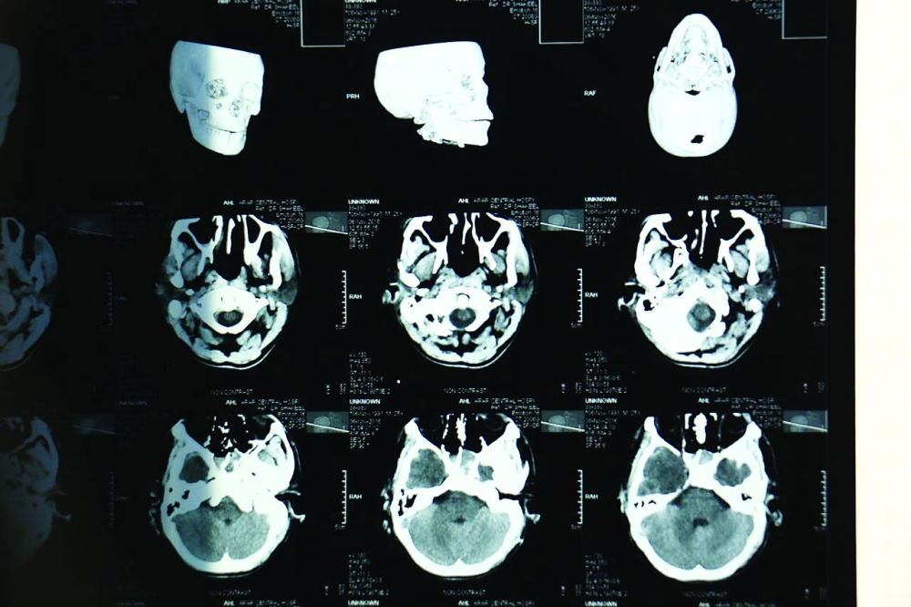 صورة أشعة لجمجمة المصاب. 