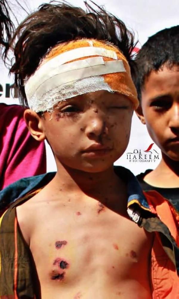 طفل يمني أصيب في قصف للميليشيات على أحد الأحياء في تعز.(متداولة)