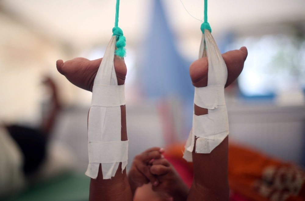 Shahid Ullah, 1, a Rohingya refugee boy, lies in a bed in the Red Cross emergency hospital near Kutupalong refugee camp near Cox's Bazar, Bangladesh October 28, 2017. Shahid was injured when his grandmother, Tahera, dropped him whilst trying to escape from military gunshots in Myanmar. REUTERS/Hannah McKay