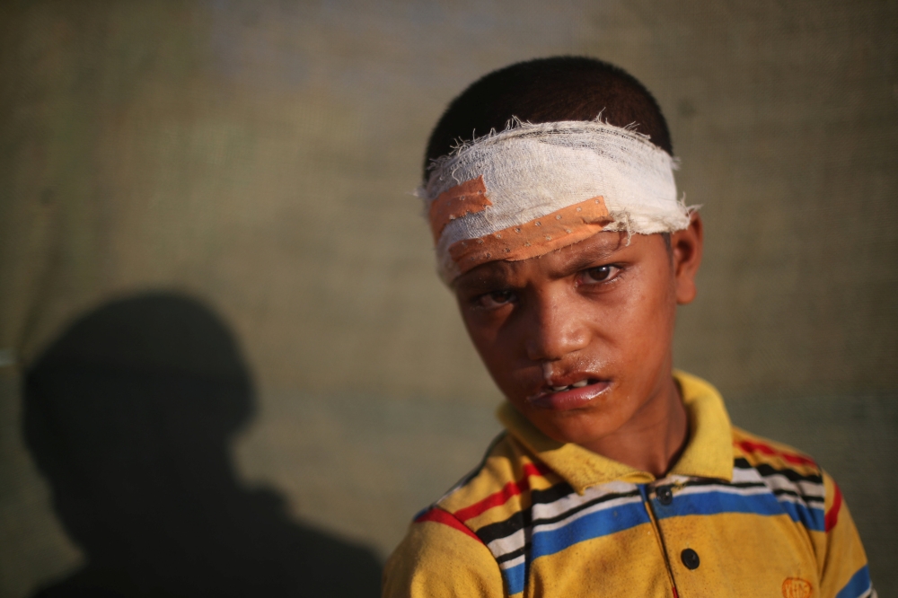 Noor Han, 7, an injured Rohingya refugee boy stands for a photograph in the Kutupalong refugee camp near Cox's Bazar, Bangladesh, November 4, 2017. Noor, who is disabled, slipped and injured his head on a water pump station. REUTERS/Hannah McKay