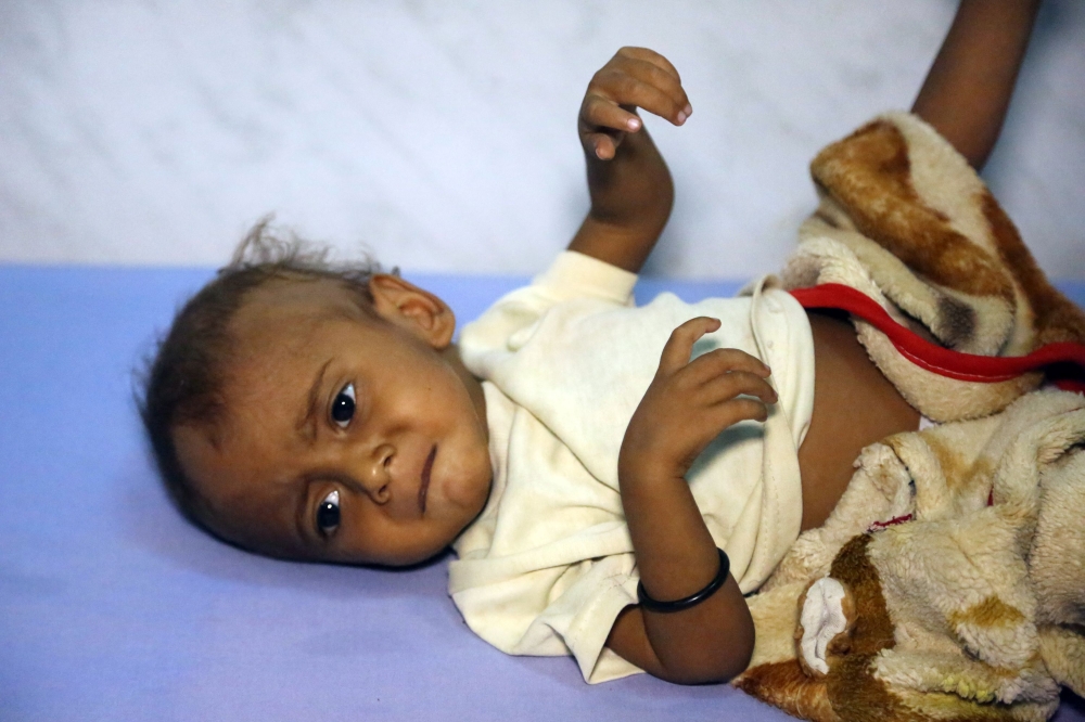 A Yemeni child receives treatment at a hospital in the Yemeni coastal city of Hodeidah on November 11, 2017. The Saudi-led coalition is still blocking desperately-needed UN aid deliveries to Yemen despite the re-opening of the port of Aden and of a land border crossing, a UN spokesman said on November 10.
The sea port at Hodeida, which is in rebel-held territory, is key to UN aid efforts as it is closest to the majority of people in need. / AFP / ABDO HYDER
