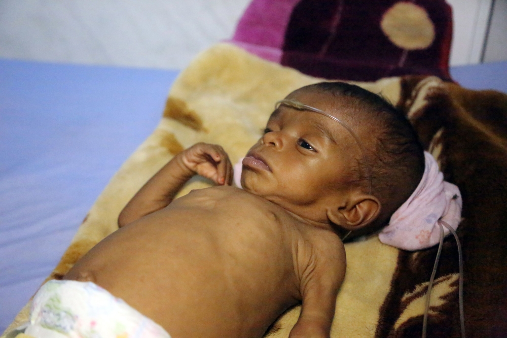 A Yemeni child receives treatment at a hospital in the Yemeni coastal city of Hodeidah on November 11, 2017. The Saudi-led coalition is still blocking desperately-needed UN aid deliveries to Yemen despite the re-opening of the port of Aden and of a land border crossing, a UN spokesman said on November 10.
The sea port at Hodeida, which is in rebel-held territory, is key to UN aid efforts as it is closest to the majority of people in need. / AFP / ABDO HYDER
