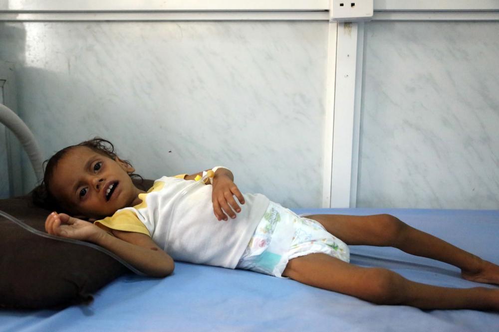 A Yemeni child receives treatment at a hospital in the Yemeni coastal city of Hodeidah on November 11, 2017. The Saudi-led coalition is still blocking desperately-needed UN aid deliveries to Yemen despite the re-opening of the port of Aden and of a land border crossing, a UN spokesman said on November 10.
The sea port at Hodeida, which is in rebel-held territory, is key to UN aid efforts as it is closest to the majority of people in need. / AFP / ABDO HYDER
