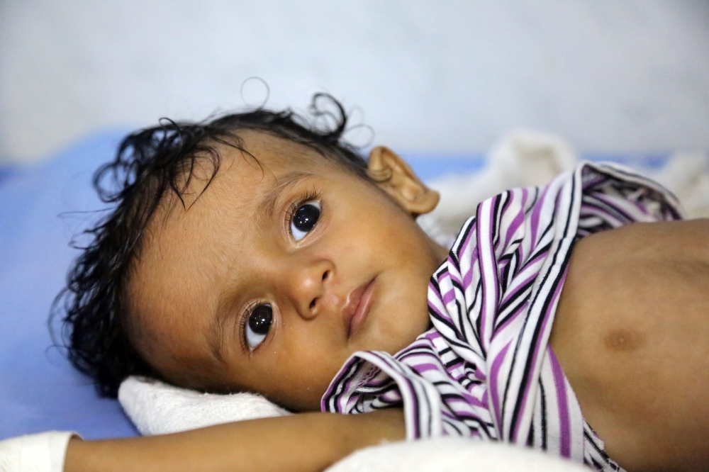 A Yemeni child receives treatment at a hospital in the Yemeni coastal city of Hodeidah on November 11, 2017. The Saudi-led coalition is still blocking desperately-needed UN aid deliveries to Yemen despite the re-opening of the port of Aden and of a land border crossing, a UN spokesman said on November 10.
The sea port at Hodeida, which is in rebel-held territory, is key to UN aid efforts as it is closest to the majority of people in need. / AFP / ABDO HYDER
