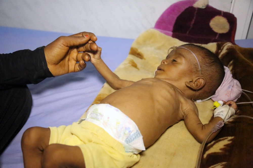 A Yemeni child receives treatment at a hospital in the Yemeni coastal city of Hodeidah on November 11, 2017. The Saudi-led coalition is still blocking desperately-needed UN aid deliveries to Yemen despite the re-opening of the port of Aden and of a land border crossing, a UN spokesman said on November 10.
The sea port at Hodeida, which is in rebel-held territory, is key to UN aid efforts as it is closest to the majority of people in need. / AFP / ABDO HYDER
