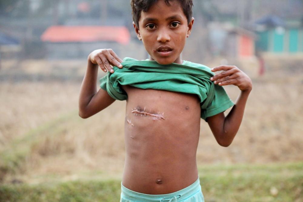 A 7-year-old Rohingya refugee, Mohammas Sohel, shows a bullet wound on his chest at the Kutupalong refugee camp near Cox's Bazar, Bangladesh December 19, 2017. REUTERS/Marko Djurica     TPX IMAGES OF THE DAY