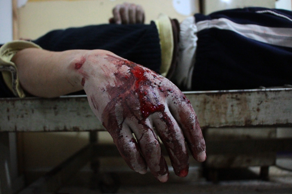 EDITORS NOTE: Graphic content / A wounded Syrian lies on a gurney inside a makeshift hospital in the rebel-held town of Douma, following air strikes by regime forces on the besieged Eastern Ghouta region on the outskirts of the capital Damascus on February 20, 2018. Regime air strikes have pushed the death toll from three days of bombing in Syria's rebel Ghouta to over 200 as Damascus pitched pro-government forces into the fray against Turkey in a Kurdish-held border region. Held by rebels since 2012, Eastern Ghouta is the last opposition pocket around Damascus and President Bashar al-Assad is keen to retake it with an apparently imminent ground assault.
 / AFP / Hamza Al-Ajweh
