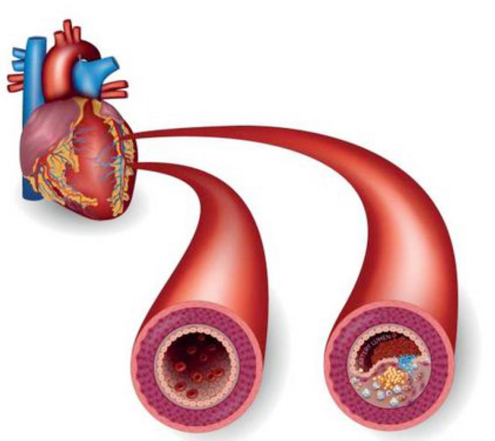 Атеросклероз артерий сердца