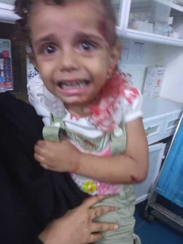 طفلة أصيبت بالقصف الحوثي