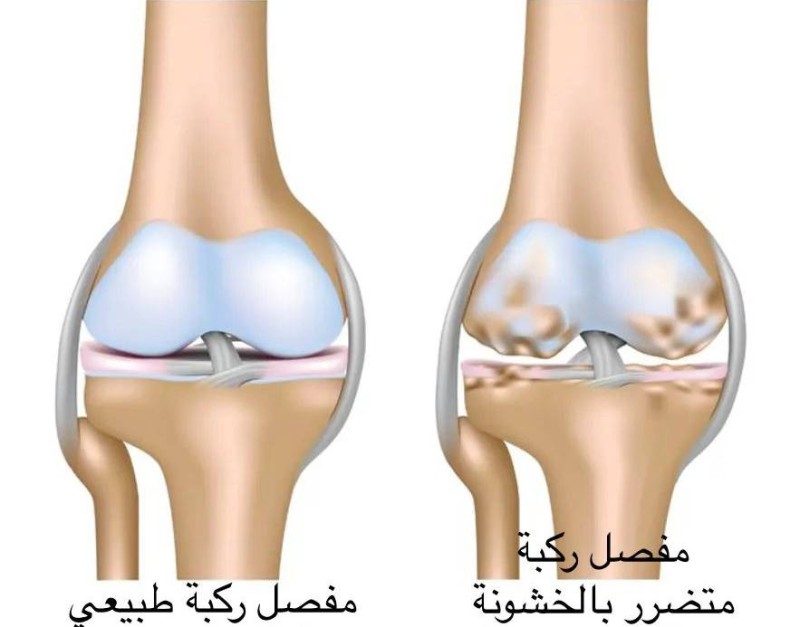 



مفصل ركبة متضرر بالخشونة